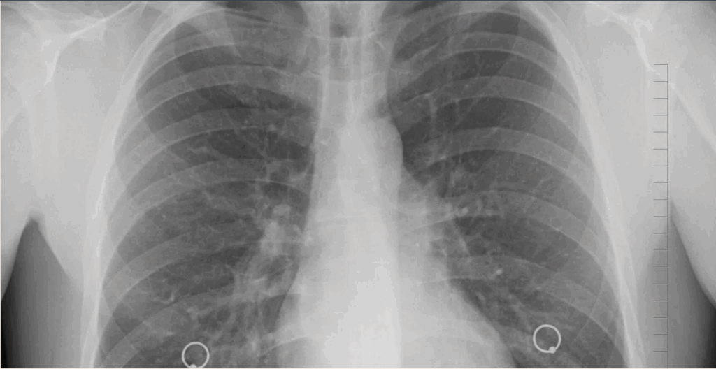cáncer de pulmón